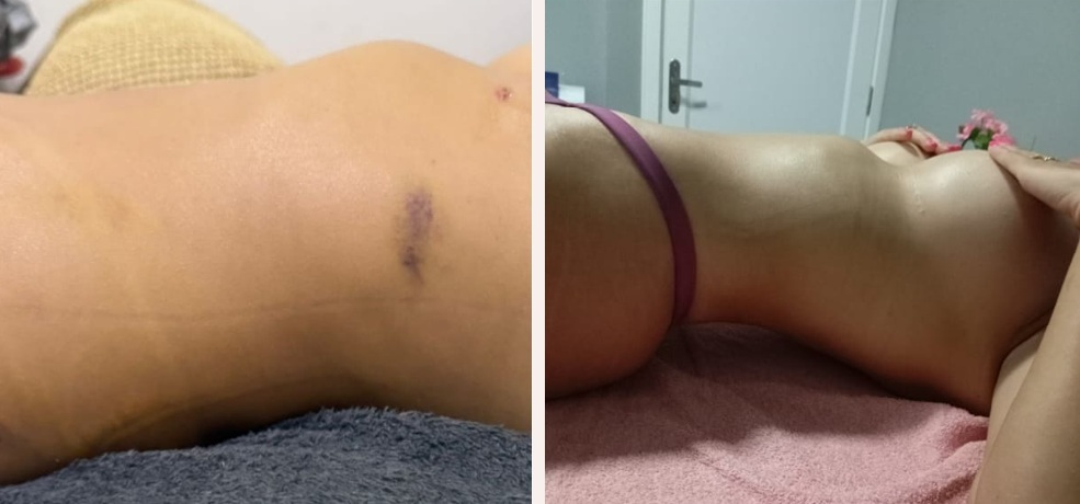 Comparativo antes e depois de drenagem linfática pós-operatória com redução de edema no abdômen
