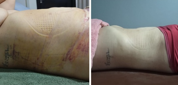 Comparativo antes e depois de tratamento pós-operatório para prevenção de fibrose