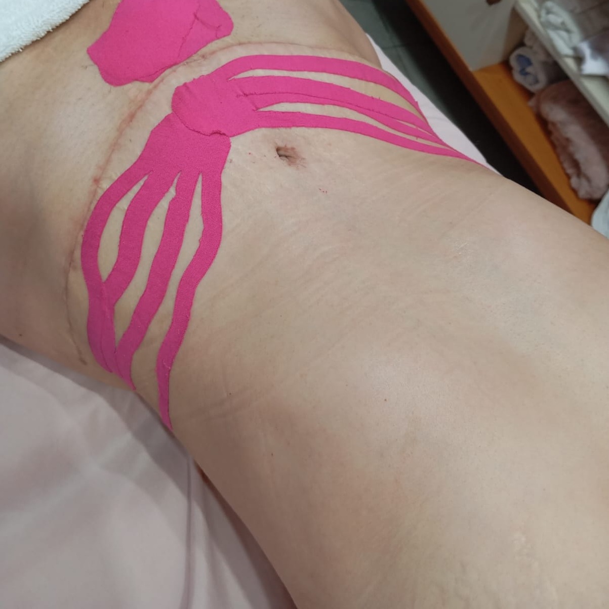 Aplicação de taping em leque no abdômen durante atendimento pós-operatório