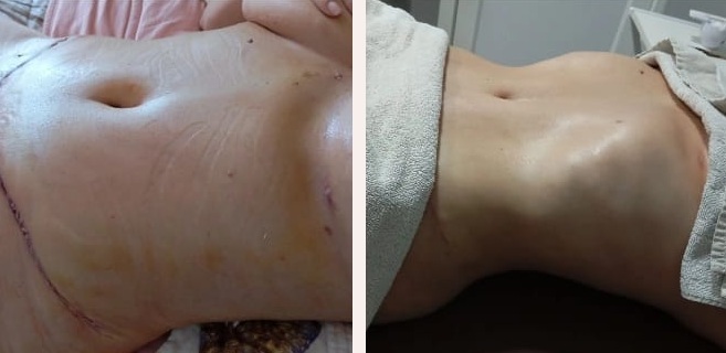 Comparativo antes e depois de pós-operatório de abdominoplastia com contorno definido